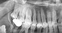 Tratamiento conservador en Ameloblastoma.